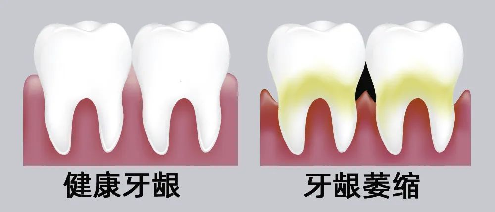 牙縫大露出“黑三角”，既塞牙又難看！還能恢復嗎？